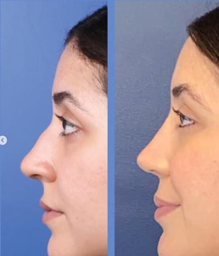 Rinoplastia caso 25 — antes y después